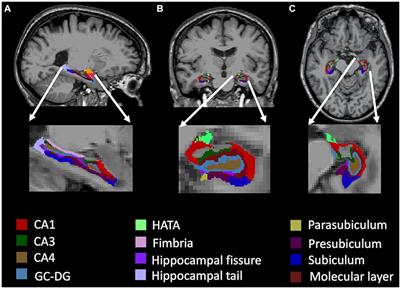 Atrophy of hippocampal subfields relates to memory decline during the pathological progression of Alzheimer’s disease